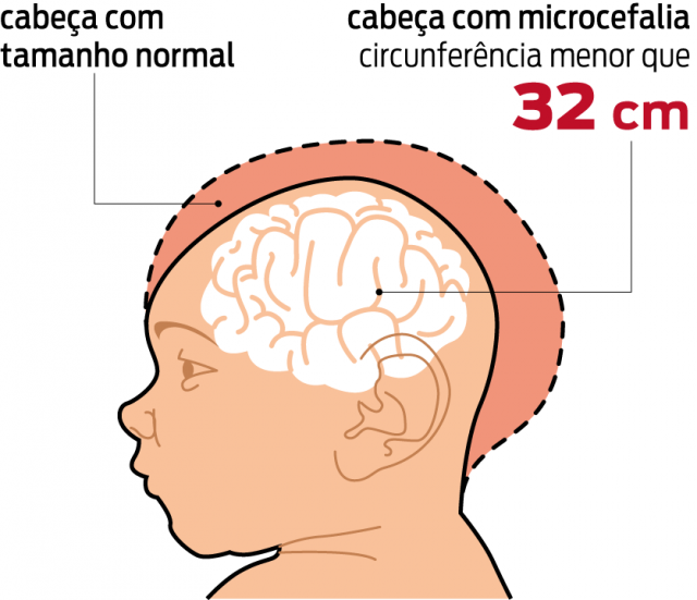 1168 Casos De Microcefalia Foram Confirmados Em Todo O País Perfil News Notícias De Três 5384