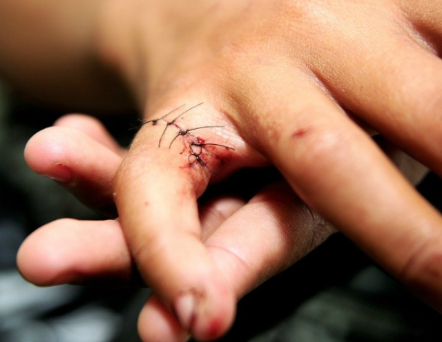 A mulher teve dois dedos com cortes profundos por causa da linha (foto: divulgação)